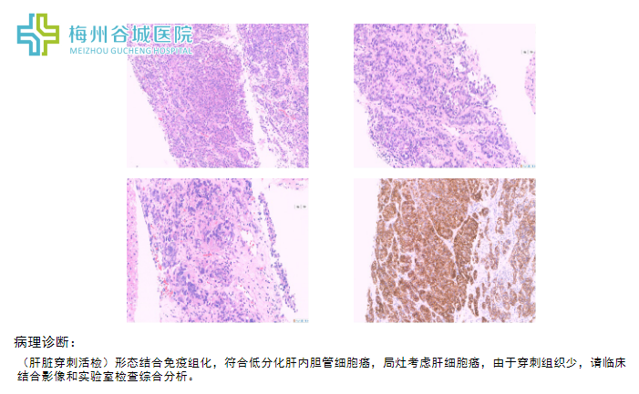 穿刺活检病理报告.png