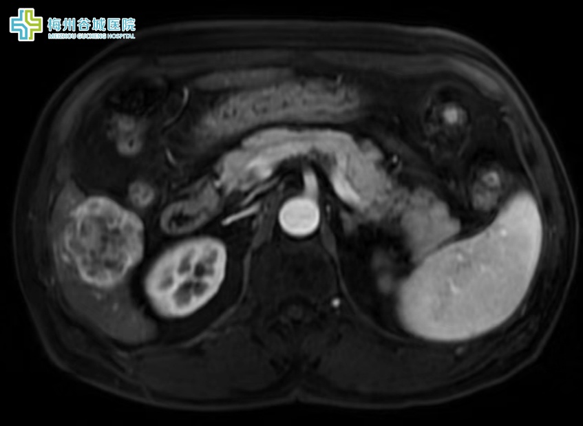 右叶病灶术前MRI.jpg